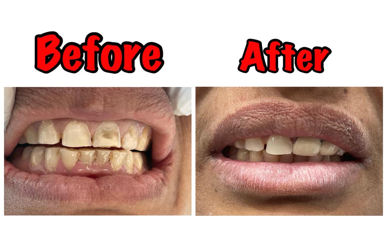 Laser Whitening & Stain Removal - After