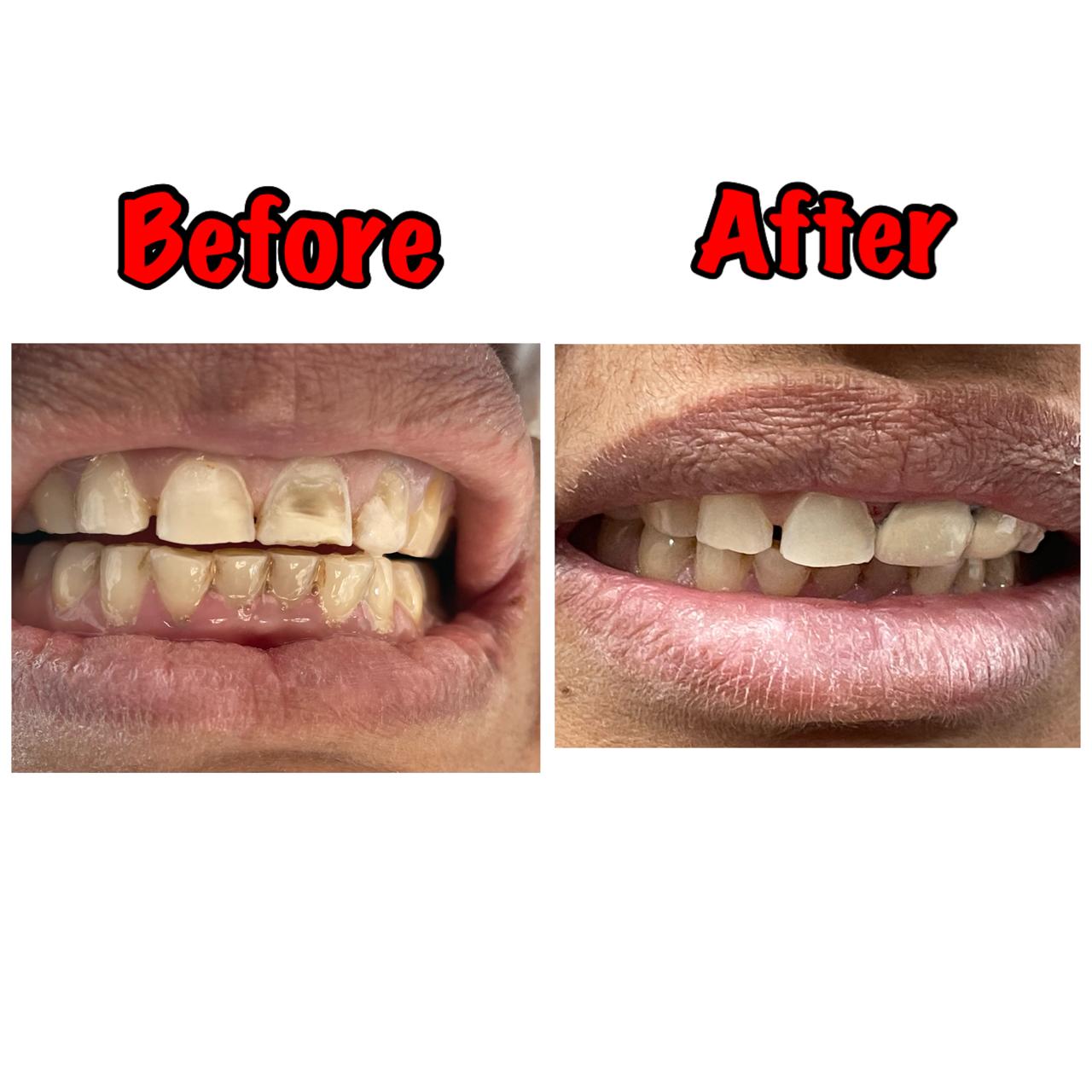 Laser Whitening & Stain Removal - Before